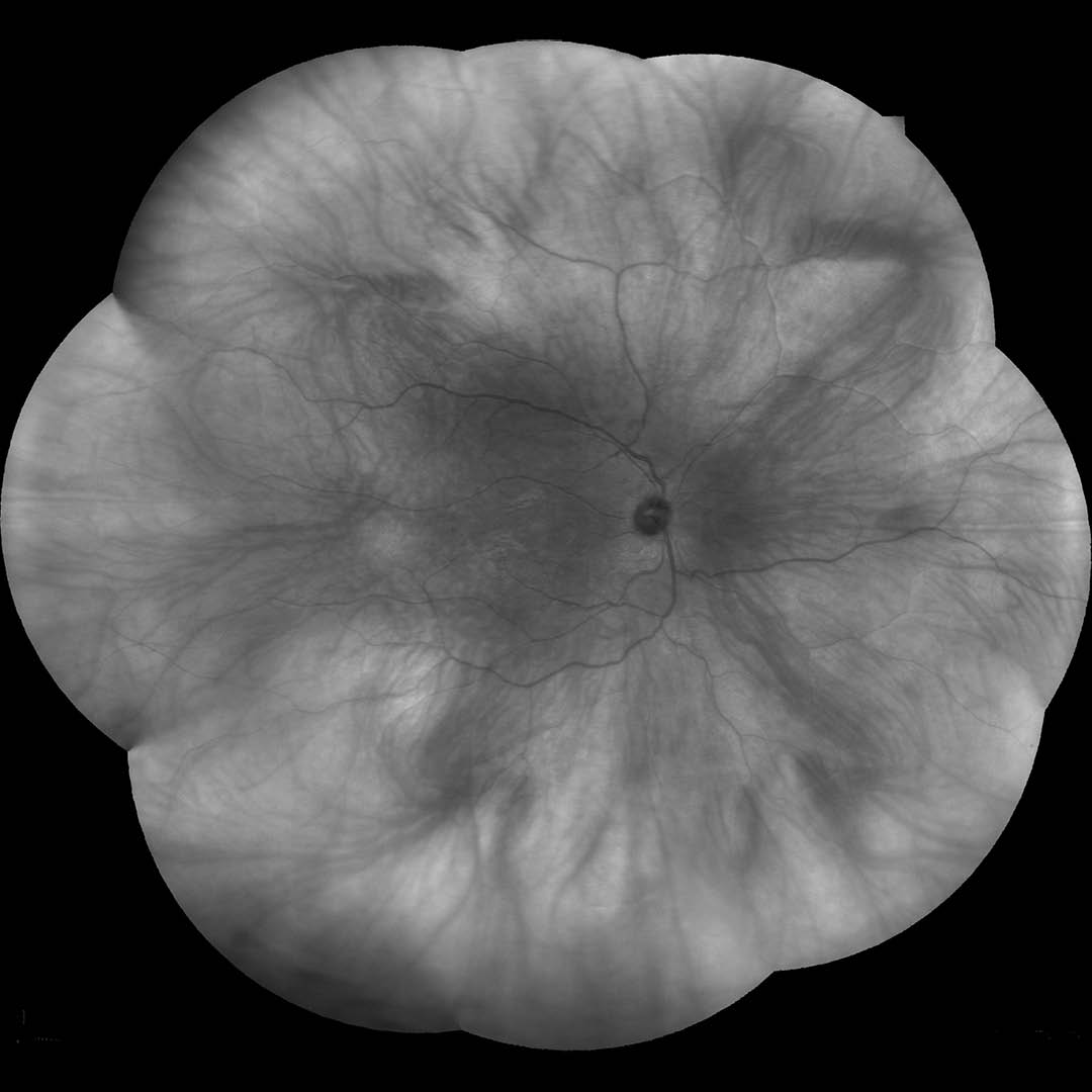 EIDON Infrared retinal image sample